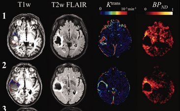 🚨 #HotTopic breaking barriers in acute intracerebral hemorrhage #ICH research!
PET + DCE-MRI methods applied to 36 patients revealed promising insights into inflammation, BBB permeability &amp; microglial activation post-ICH and brain recovery. 🧠

Check it : doi.org/10.1177/027167…