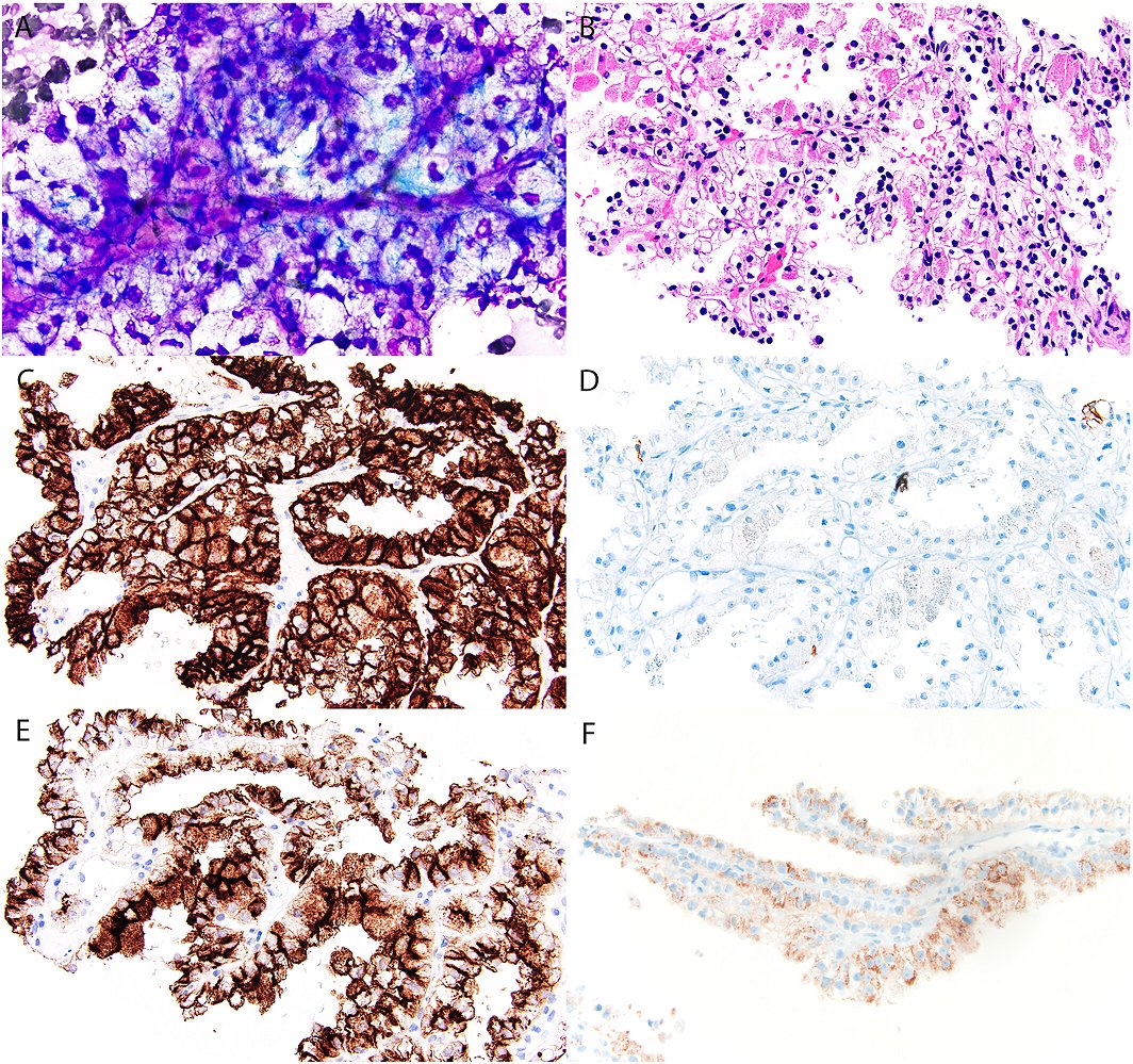 Cancer Cytopathology (@cancercytopath) on Twitter photo #OpenAccess review | Role of renal mass biopsy for diagnosis and management: Review of current trends and future directions
acsjournals.onlinelibrary.wiley.com/doi/10.1002/cn…
#CytoPath <a href="/bonnie_choy/">Bonnie Choy, MD</a> <a href="/NayarRitu/">Ritu Nayar, MD</a> #OpenAccess review | Role of renal mass biopsy for diagnosis and management: Review of current trends and future directions
acsjournals.onlinelibrary.wiley.com/doi/10.1002/cn…
#CytoPath <a href="/bonnie_choy/">Bonnie Choy, MD</a> <a href="/NayarRitu/">Ritu Nayar, MD</a>