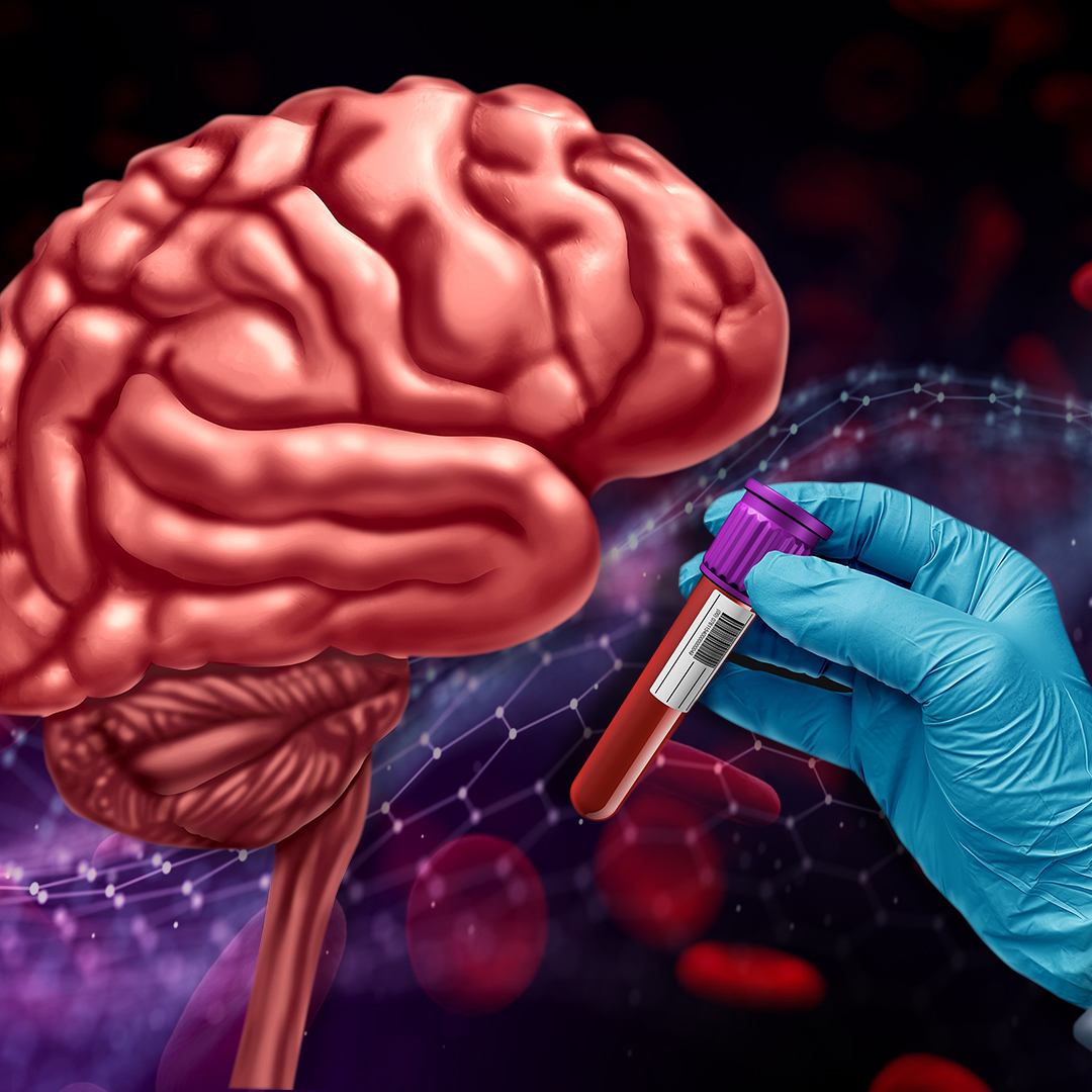 Blood-based biomarkers could redefine #AlzheimersDisease testing—making early and accurate detection more accessible and less invasive. Get insights from experts at #CTAD2024. Read blog&gt;&gt; bit.ly/3ZmKi5C