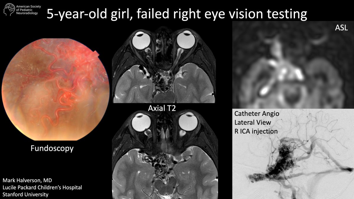 Case of the week: 5-year-old girl, failed right eye vision testing bit.ly/3ZUS88a Mark Halverson, MD, Lucile Packard Children’s Hospital, Stanford University #PediNeuroRad #MedEd #FOAMrad #PedsRad