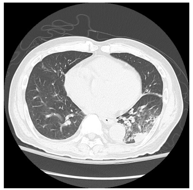 ASM (@asmicrobiology) on Twitter photo A case report published in <a href="/ASMCaseReports/">ASMCaseReports</a> suggests Legionella cardiaca—a species described in 2012, with no other report of infections since then—is an opportunistic pathogen & may cause pneumonia or Legionnaires’ disease in immunocompromised patients. asm.social/2f5 A case report published in <a href="/ASMCaseReports/">ASMCaseReports</a> suggests Legionella cardiaca—a species described in 2012, with no other report of infections since then—is an opportunistic pathogen & may cause pneumonia or Legionnaires’ disease in immunocompromised patients. asm.social/2f5