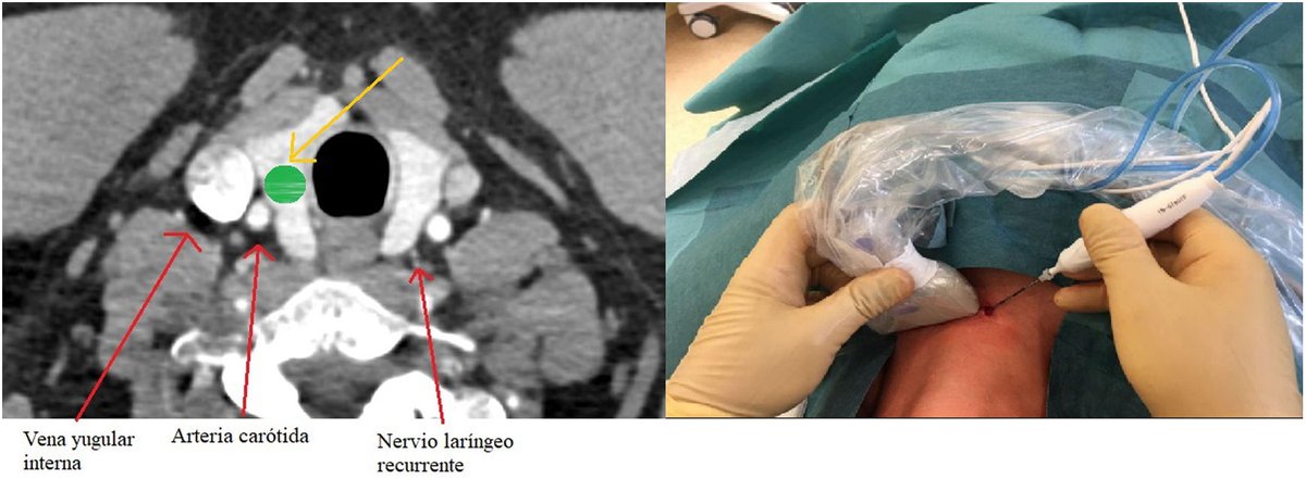 @RevistaRADIOLOGIA (@revistaradiolo2) on Twitter photo ÂżRecuerdas la magnĂfica serie sobre Intervencionismo por ecografĂa dirigida por <a href="/JoseLuisdelCura/">Jose Luis del Cura</a>? Pues aquĂ estĂĄn todos los artĂculos juntos. No te pierdas el Virtual Special Issue que se publicĂł en <a href="/RevistaRADIOLO2/">@RevistaRADIOLOGIA</a> en 2024
elsevier.es/es-revista-rad⊠¿Recuerdas la magnĂfica serie sobre Intervencionismo por ecografĂa dirigida por <a href="/JoseLuisdelCura/">Jose Luis del Cura</a>? Pues aquĂ estĂĄn todos los artĂculos juntos. No te pierdas el Virtual Special Issue que se publicĂł en <a href="/RevistaRADIOLO2/">@RevistaRADIOLOGIA</a> en 2024
elsevier.es/es-revista-radâŠ