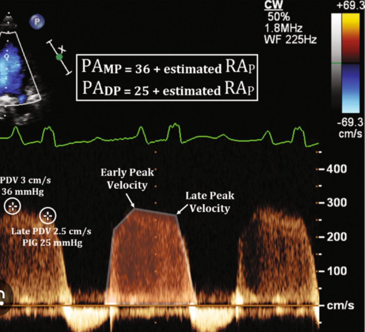 Pulmonary Regurgitation is
often an overlooked window to PA hemodynamics (PR CWD end velocity for PA diastolic pressure &amp; peak PR CWD velocity for PA mean) #echofirst