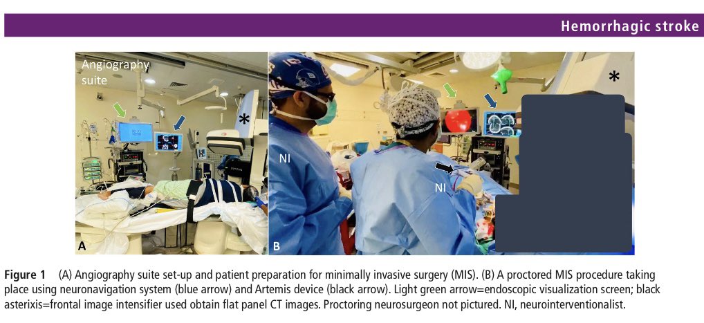 Our recent publication about one of our unique and exciting works in Texas. 

jnis.bmj.com/content/early/…

Key messages:

1- ICH is very common in developing countries (30-50% of all strokes) vs. 10-15% in developed countries. 

2- High likelihood that early/emergent ICH evacuation