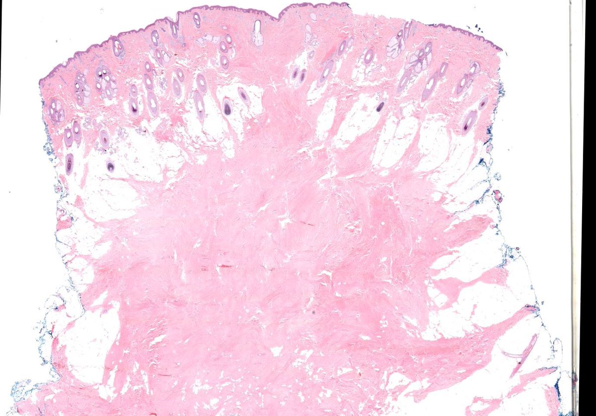 30 M. diabetic. subQ nodule post neck. 
Digital slide kikoxp.com/posts/3748. 
What syndrome-associated tumor does it mimic? 
Answer ✅ youtu.be/JJJF6zEabt0?si…  
#Pathology #dermpath #dermatology #dermtwitter #BSTpath