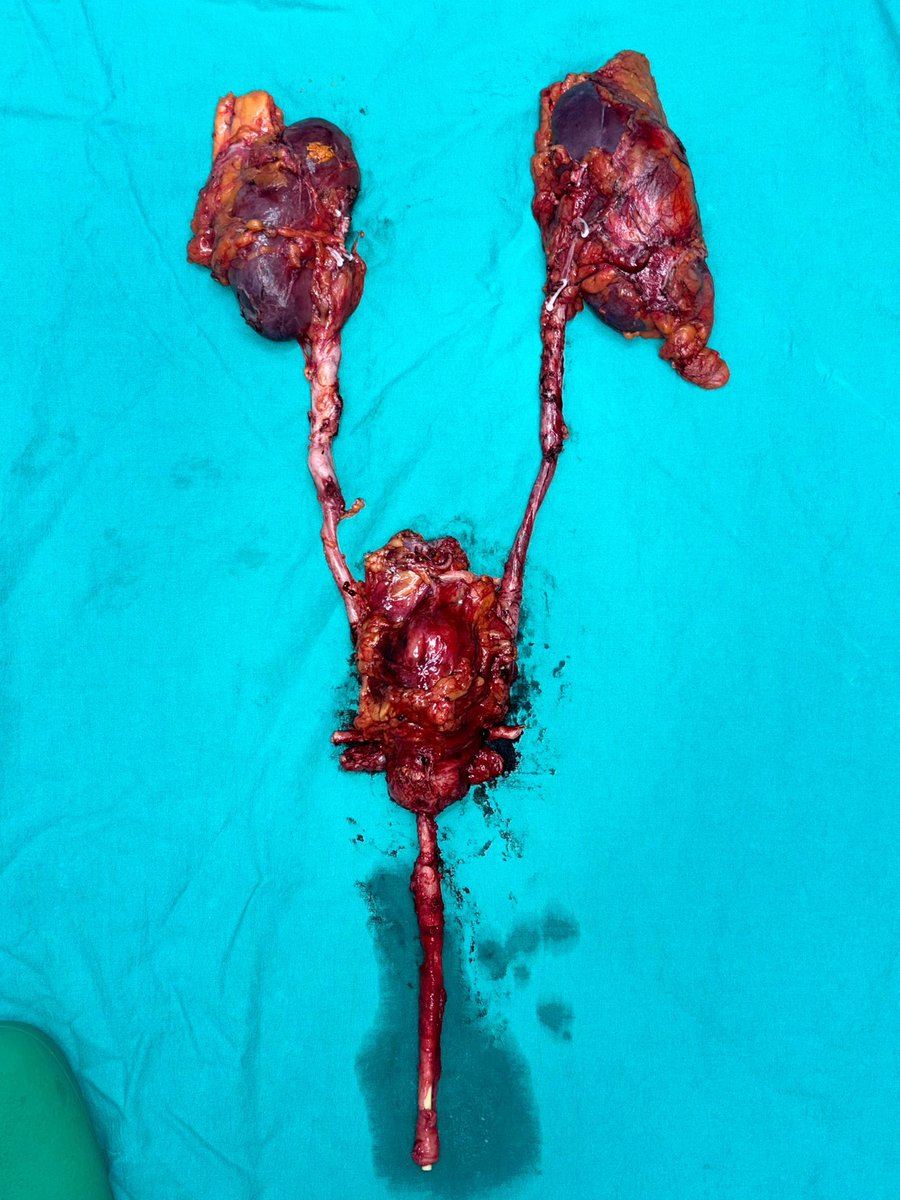Today’s case: bilateral high grade ureteral TCC occupying half of the ureteral lenght ➡️ laparoscopic bilateral nephrectomy + laparoscopic cystoprostatectomy + urethrectomy. Basically we call this procedure urology-ectomy 😉