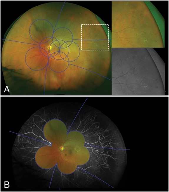 There's new insight into risk for #DiabeticRetinopathy (DR) progression. Peripheral lesions on ultrawide field fluorescein angiography are associated with significant risk of worsening DR. Read the results of this #NEIfunded #PostHocAnalysis here:  
bit.ly/49SjsHD