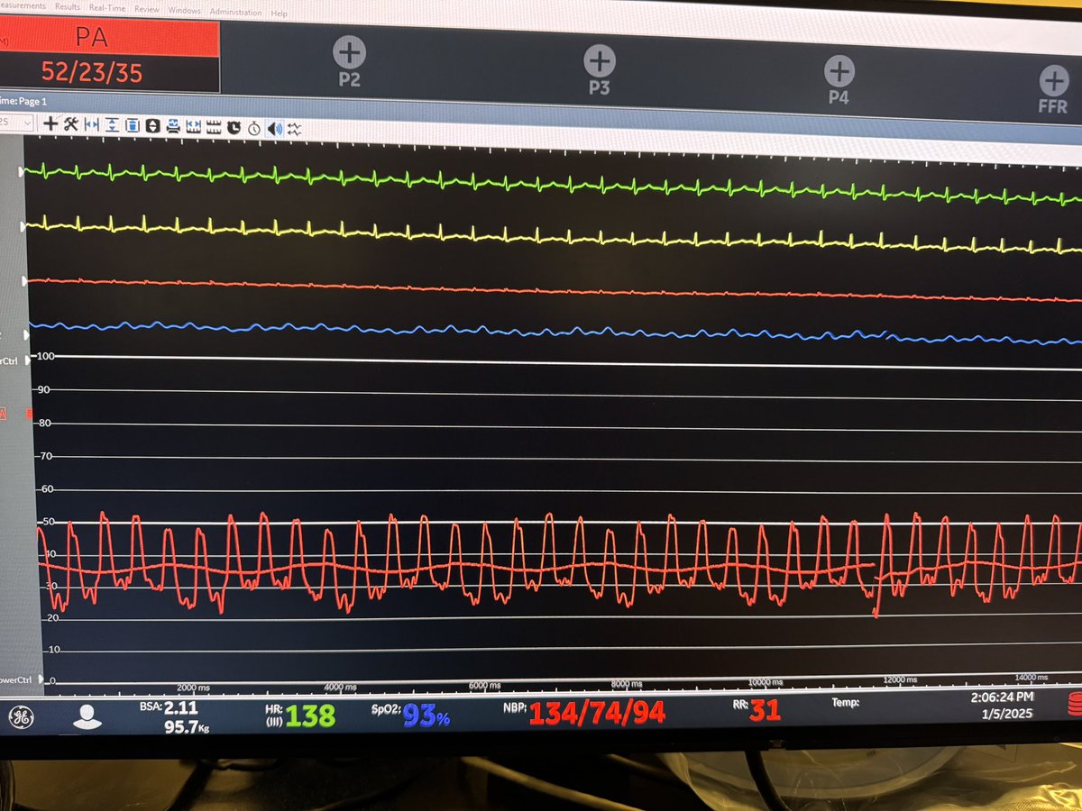 Jonathan Paul (@jonathan_paulmd) on Twitter photo Normotensive shock in acute PE is more common than you think! A full RHC prior to PE intervention will save you from an “unexpected” crashing patient. Also, large clot burden does not always equal low cardiac output! <a href="/SandeepNathanMD/">Sandeep Nathan, MD, MSc</a> <a href="/TheRealDoctorOs/">Osman Ahmed</a> <a href="/UChicagoCardio/">UChicagoCardio</a> Normotensive shock in acute PE is more common than you think! A full RHC prior to PE intervention will save you from an “unexpected” crashing patient. Also, large clot burden does not always equal low cardiac output! <a href="/SandeepNathanMD/">Sandeep Nathan, MD, MSc</a> <a href="/TheRealDoctorOs/">Osman Ahmed</a> <a href="/UChicagoCardio/">UChicagoCardio</a>