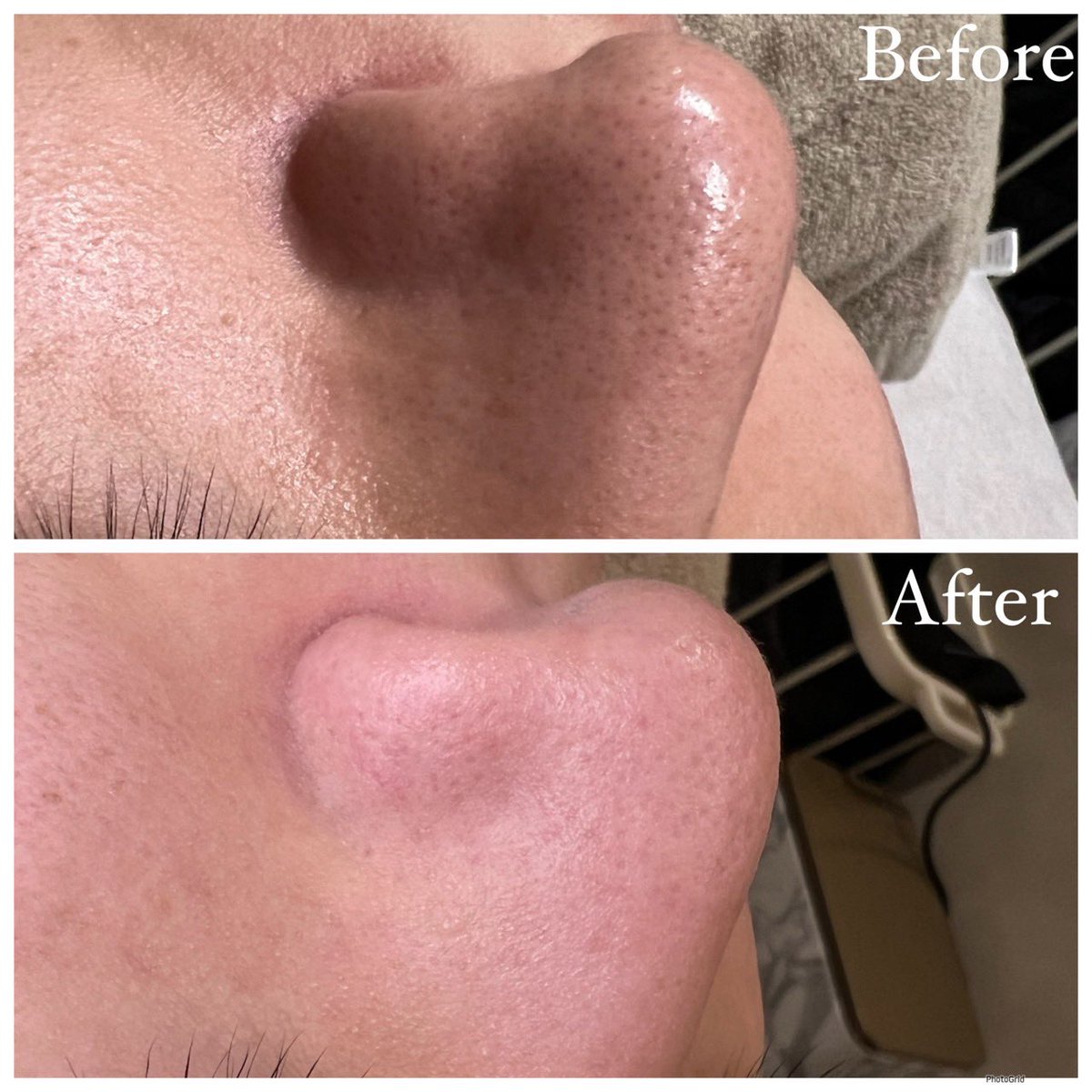 【モニター募集】

当店で毛穴洗浄を受けられた方のbefore→afterです！！

モニター募集します😊✨

定価9800円→5000円で今なら受けれます✨

DMまたは、ホットペッパーからご予約ください！

beauty.hotpepper.jp/kr/slnH0007299…