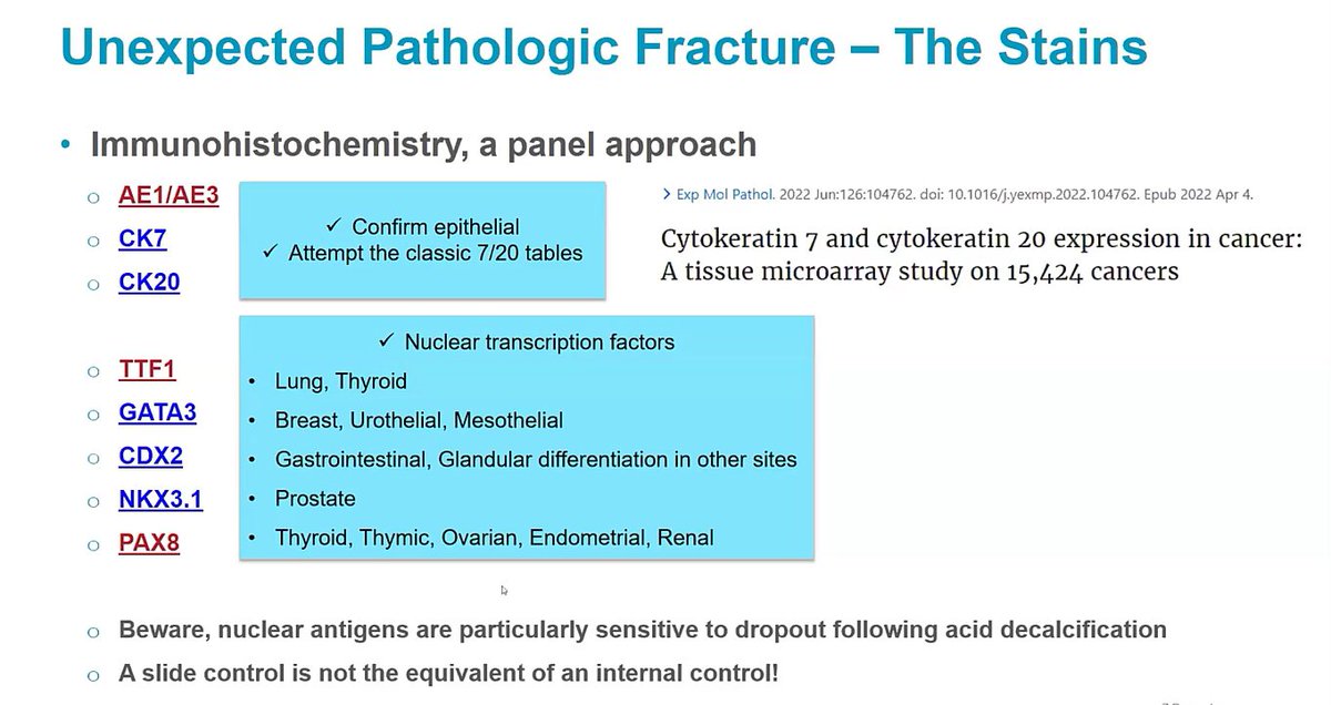 Janiranavarro's tweet photo. #JobPrepBootcamp
The unexpected pathologic fracture-what IHC stains to order?
-CK7/CK20 are not as helpful as nuclear transcription factors to rule in a diagnosis
-Beware that nuclear antigens are sensitive to acid decalcification

Dr. Clay #pathology #PathX #PathTwitter