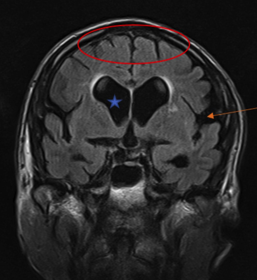 Normal Pressure Hydrocephalus (NPH) Imaging Findings:
1- Ventriculomegaly out of proportion to cortical atrophy: blue star. 
2- Disproportionately enlarged subarachnoid space hydrocephalus (DESH): orange arrow 
3- Crowding of the sulci at the vertex: red circle. 

#neurotip