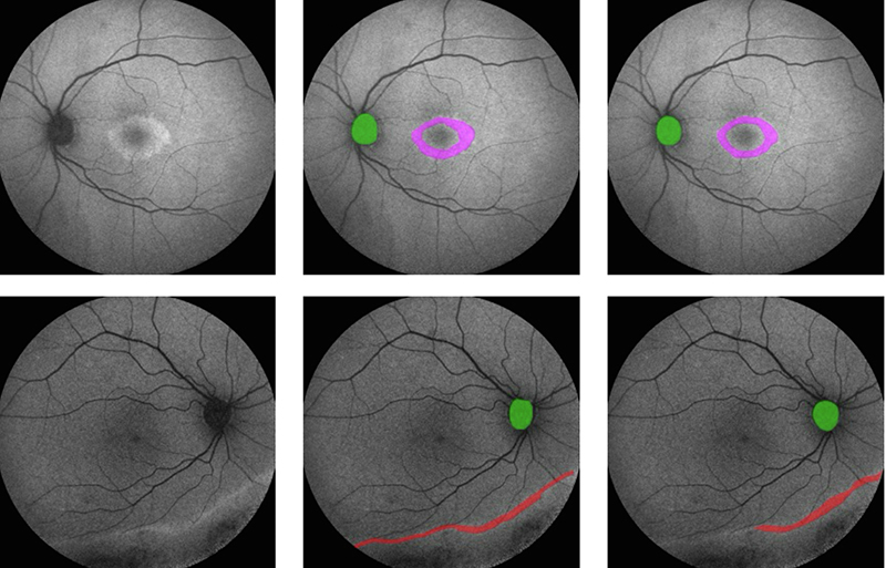 Researchers and clinicians at <a href="/UCLeye/">UCL Institute of Ophthalmology</a> and <a href="/MoorfieldsBRC/">NIHR Moorfields BRC</a>, have developed a deep learning model, ‘AIRDetect’ to process fundus autofluorescence (FAF) retinal imaging, a critical imaging modality for diagnosing and managing inherited retinal diseases. ucl.ac.uk/ioo/news/2025/…