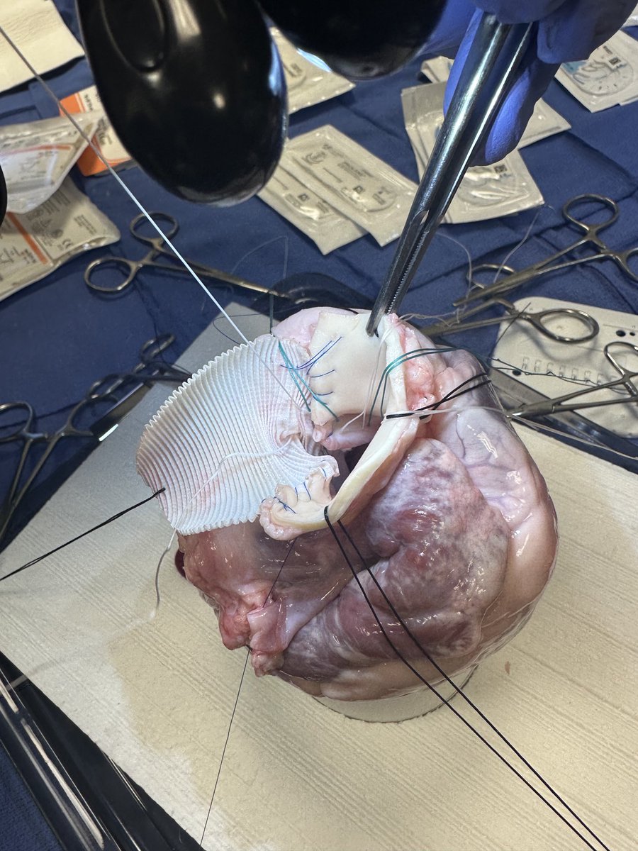 Matthew Janko, MD (@matthewjankomd) on Twitter photo Complex #heart #surgery #mentorship is alive & well <a href="/GaHeart_NGHS/">Georgia Heart Institute</a>! “Practice like you play” w/ pig hearts so human heart surgery = perfect. Thanks <a href="/sloaneguy/">T. Sloane Guy, MD, MBA</a> <a href="/EdwardsLifesci/">Edwards Lifesciences</a> <a href="/myNGHS/">NGHS</a> <a href="/STS_CTsurgery/">The Society of Thoracic Surgeons</a> <a href="/AATSHQ/">AATS</a> <a href="/IntuitiveSurg/">Intuitive</a> Complex #heart #surgery #mentorship is alive & well <a href="/GaHeart_NGHS/">Georgia Heart Institute</a>! “Practice like you play” w/ pig hearts so human heart surgery = perfect. Thanks <a href="/sloaneguy/">T. Sloane Guy, MD, MBA</a> <a href="/EdwardsLifesci/">Edwards Lifesciences</a> <a href="/myNGHS/">NGHS</a> <a href="/STS_CTsurgery/">The Society of Thoracic Surgeons</a> <a href="/AATSHQ/">AATS</a> <a href="/IntuitiveSurg/">Intuitive</a>