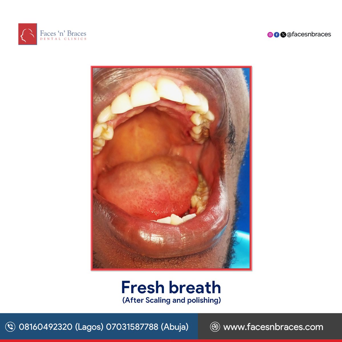 facesnbraces's tweet photo. Scale &amp; Polish Your Way to a Healthier Smile!

• Scaling removes plaque &amp; tartar, preventing gum disease
• Polishing leaves your teeth smooth &amp; shiny, boosting confidence
• Prevents bad breath &amp; gum inflammation
• Maintains good oral hygiene

Schedule your appointment today! https://t.co/kg6Zj0ngXP