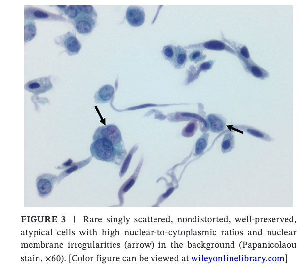 Diagnostic Cytopath (@diagnosticcyto) on Twitter photo New article alert <a href="/DiagnosticCyto/">Diagnostic Cytopath</a>, Open Access. Thermal Cautery Artifact in Urine Cytology: An Uncommon Finding but a Potential Pitfall onlinelibrary.wiley.com/doi/10.1002/dc… <a href="/PapSociety/">Papanicolaou Society</a> <a href="/IACytology/">International Academy Cytology</a> <a href="/aakasharmand/">Zubair Baloch</a> <a href="/AzizaNassar2/">Aziza Nassar</a> #cytopath New article alert <a href="/DiagnosticCyto/">Diagnostic Cytopath</a>, Open Access. Thermal Cautery Artifact in Urine Cytology: An Uncommon Finding but a Potential Pitfall onlinelibrary.wiley.com/doi/10.1002/dc… <a href="/PapSociety/">Papanicolaou Society</a> <a href="/IACytology/">International Academy Cytology</a> <a href="/aakasharmand/">Zubair Baloch</a> <a href="/AzizaNassar2/">Aziza Nassar</a> #cytopath