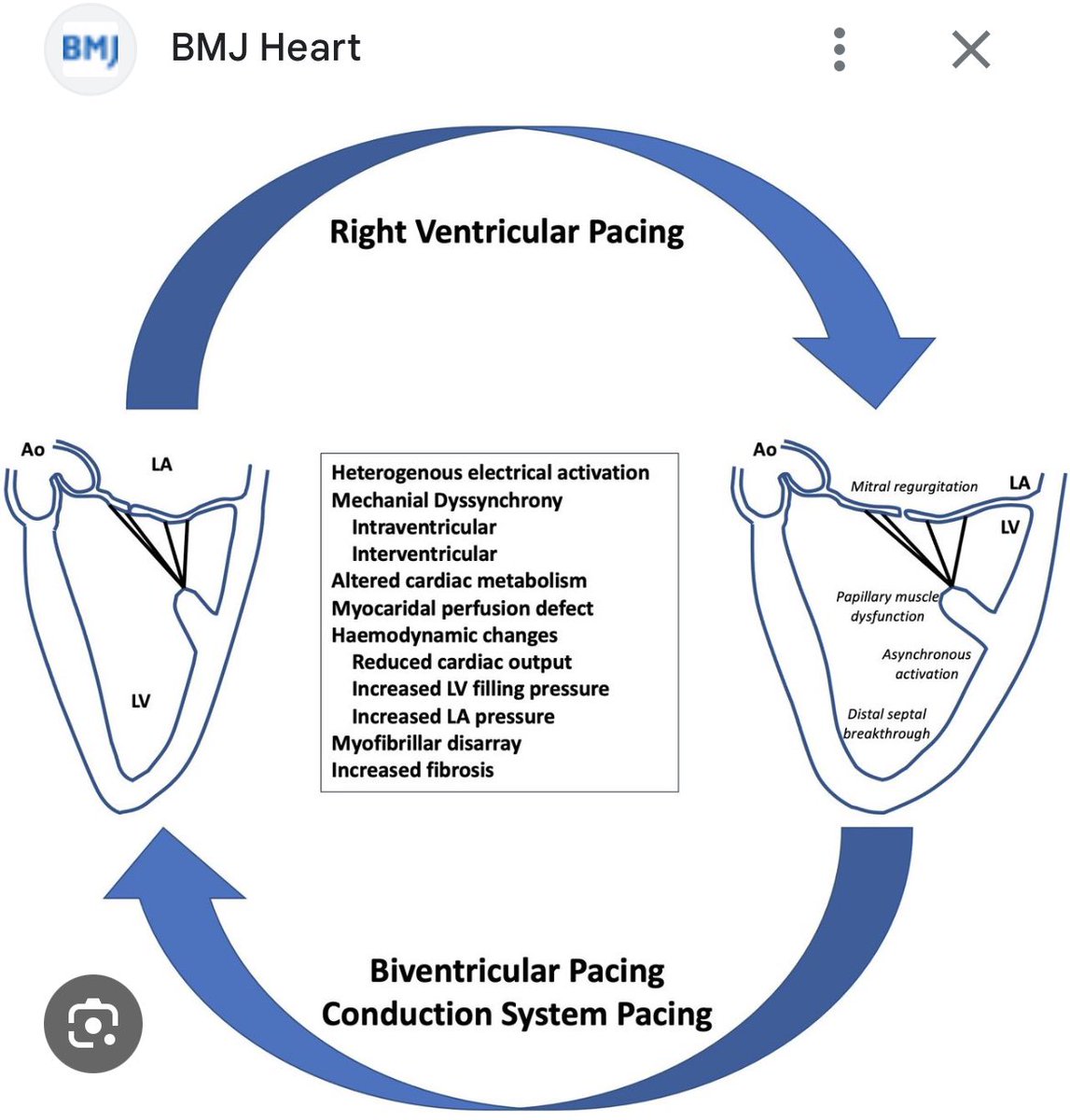 Basalus's tweet photo. 📢 Spotlight on Pacing-Induced Cardiomyopathy (PICM):A significant but under-recognized complication of chronic RV pacing. Early diagnosis and advanced pacing strategies like CRT or CSP are key to improving outcomes. Let’s bring awareness to this critical issue! #Cardiology #PICM https://t.co/5y1glS9cIy