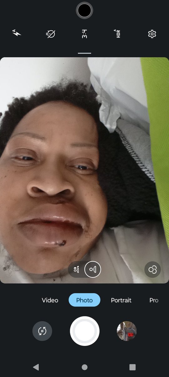 kitak14's tweet photo. Me this morning over 20 stitches in my mouth https://t.co/MWWbM40LuH