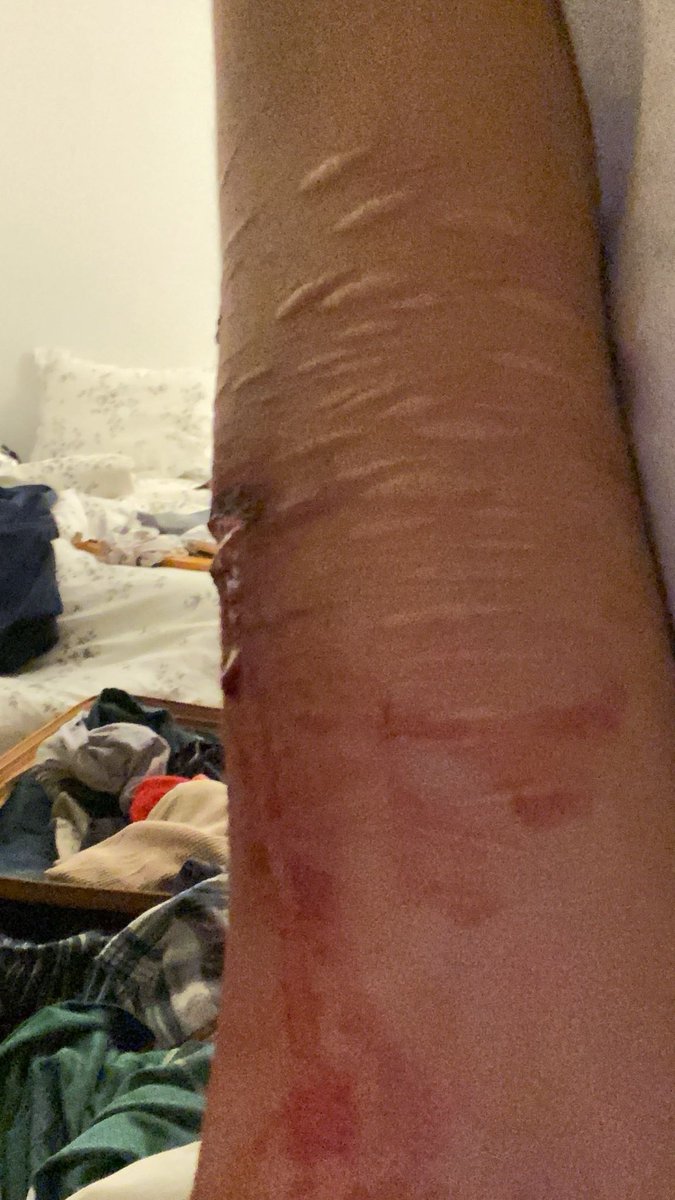 omggilostatooth's tweet photo. did my deepest cut ever last night ! hit baby beans :D https://t.co/gwbJO8xTkt