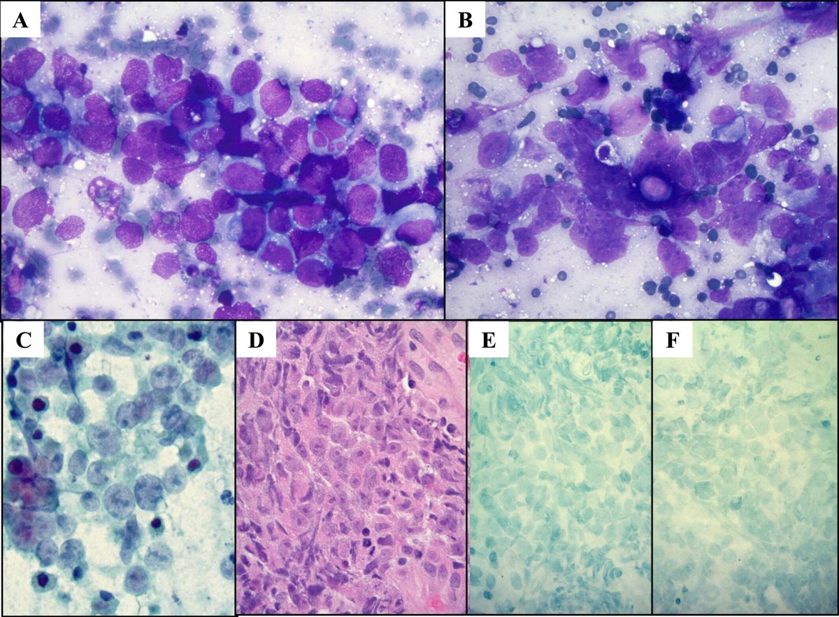 #OpenAccess: FNA and effusion cytology of thoracic SMARCA4–deficient undifferentiated tumor and SMARCA4-deficient NSCLC: A multi-institutional experience with 27 patients

acsjournals.onlinelibrary.wiley.com/doi/full/10.10…

#CytoPath <a href="/PathPro/">Liron Pantanowitz</a> <a href="/SatturwarSwati/">Swati Satturwar</a> <a href="/smlungpathguy/">Sanjay Mukhopadhyay</a> <a href="/ZallesNicole/">Nicole Zalles MD, PhD</a>