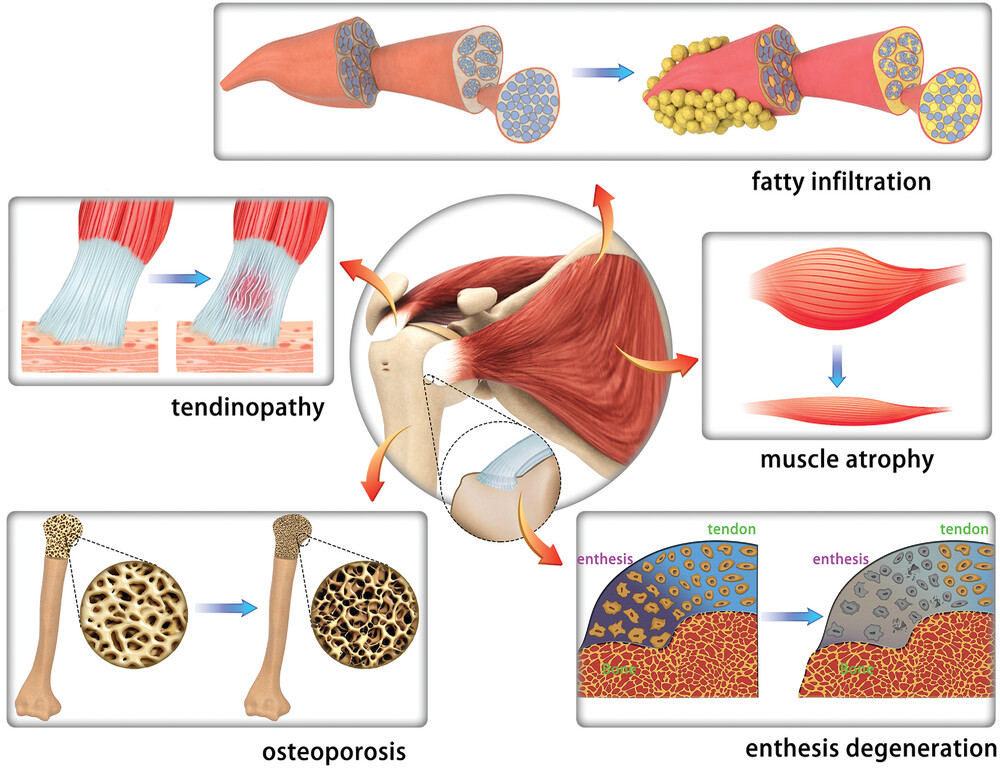 Ageing-related pathological degenerations in rotator cuff 

☑️muscle atrophy
☑️muscle fatty infiltration
☑️degenerative tendinopathy
☑️enthesis degeneration
☑️osteoporosis

#ageing #musclerecovery #tendon #bone #shoulder  

onlinelibrary.wiley.com/doi/full/10.10…