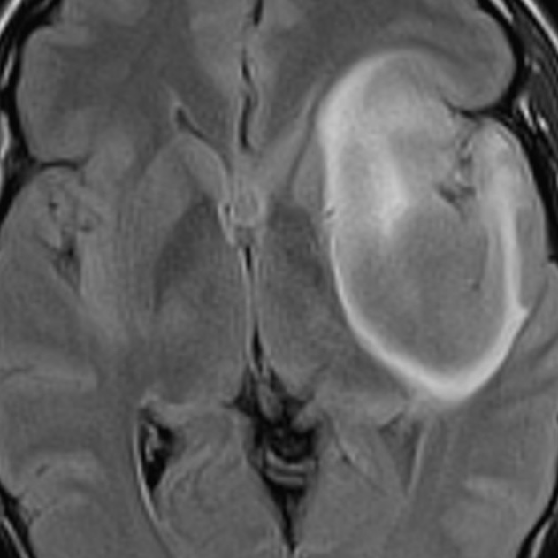 Beautiful example of T2-FLAIR mismatch in a proven IDH-mutant astrocytoma. Central FLAIR suppression with a hyperintense peripheral rim. Suggestive of IDH-mutant astrocytoma (but can also be seen in diffuse astrocytoma MYB or MYBL1 altered and angiocentric glioma).