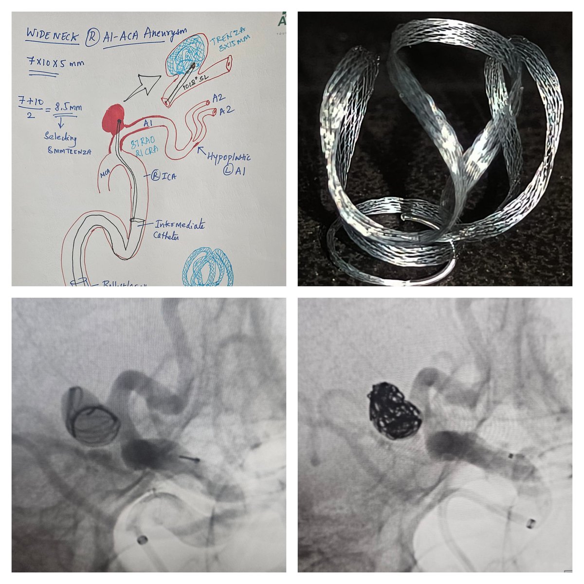 SharathKumarGG7's tweet image. Trenza assisted coiling of a wide neck unruptured aneurysm. First case for the Apollo Karnataka region! The Trenza Embolization Device (TED) is an innovative new intrasaccular device for medium-to large-sized 
aneurysms @ApolloKarnataka #coiling #aneurysm #BrainAneurysm