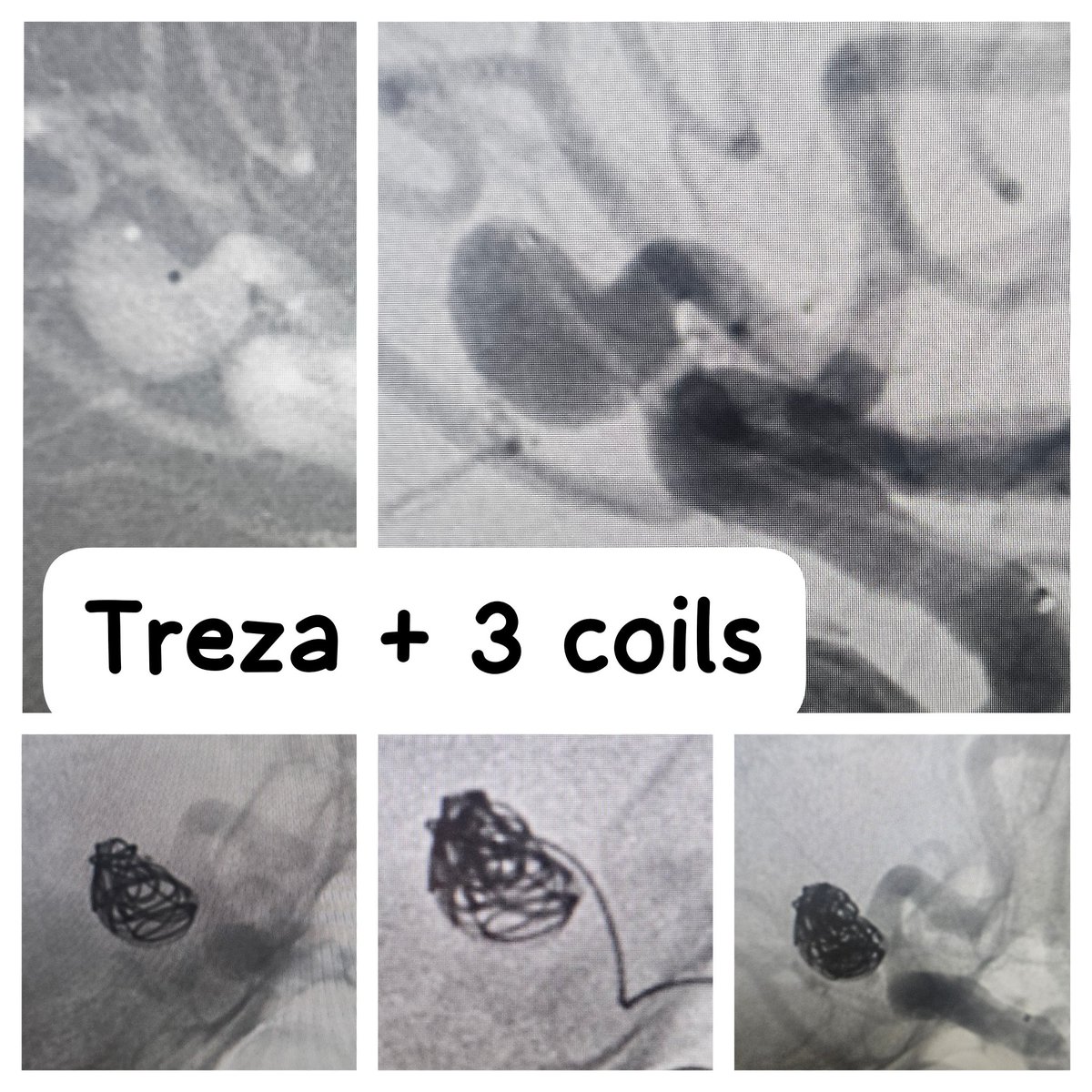 SharathKumarGG7's tweet image. Trenza assisted coiling of a wide neck unruptured aneurysm. First case for the Apollo Karnataka region! The Trenza Embolization Device (TED) is an innovative new intrasaccular device for medium-to large-sized 
aneurysms @ApolloKarnataka #coiling #aneurysm #BrainAneurysm