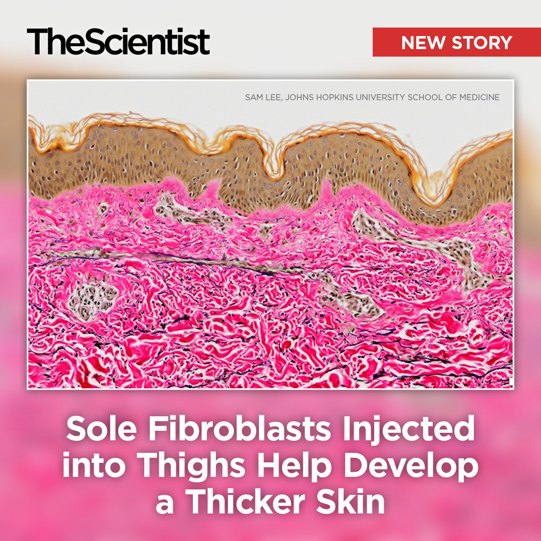 TheScientistLLC's tweet image. Grafting cells from the thick skin of soles into fragile thigh skin helped it become thicker, which could benefit people with amputations to better tolerate prosthetics.
Read more: bit.ly/4hponSN