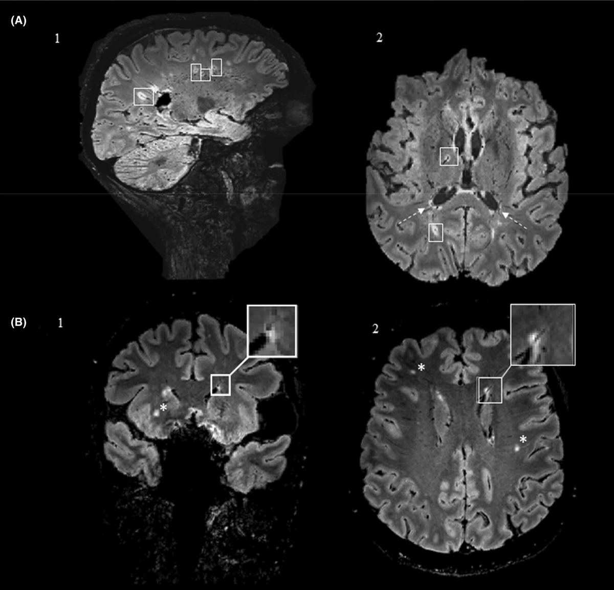 Dr. Brandon Beaber (@brandon_beaber) on Twitter photo The central vein sign (a small vein in the center of white matter lesions) is linked to multiple sclerosis, but it is not perfect. in this study differentiating between migraine associated white matter abnormalities and MS, specificity was only 85.7% …adachejournal.onlinelibrary.wiley.com/doi/10.1111/he… The central vein sign (a small vein in the center of white matter lesions) is linked to multiple sclerosis, but it is not perfect. in this study differentiating between migraine associated white matter abnormalities and MS, specificity was only 85.7% …adachejournal.onlinelibrary.wiley.com/doi/10.1111/he…