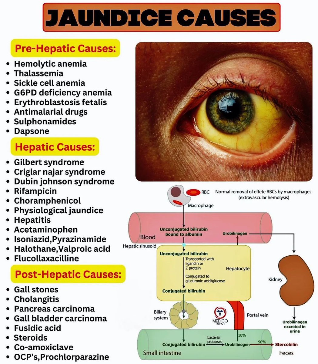 Doctors__squad's tweet photo. Causes of jaundice and bilirubin metabolism. https://t.co/DGFhmxtRJL
