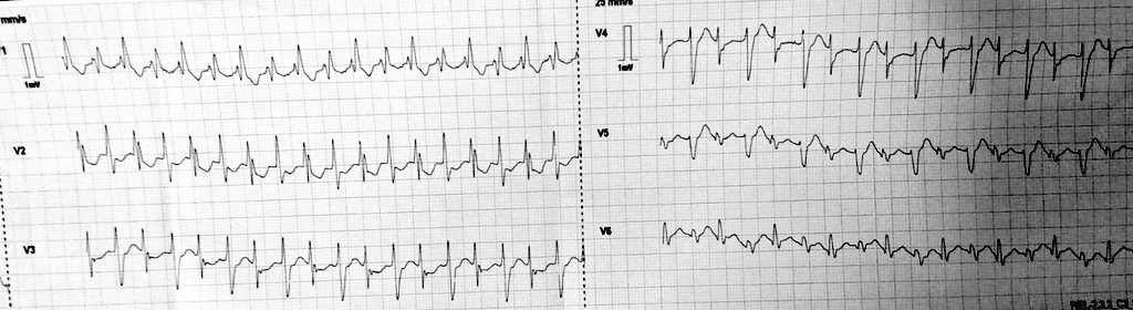 OnlyECG (@onlyecg1) on Twitter photo Rhythm challenge. Dx?
<a href="/DidlakeDW/">David Didlake</a> <a href="/DrRazi4/">Dr Razi</a> <a href="/ecgandrhythmRoe/">Dr. Andreas Roeschl</a> <a href="/ecgrhythms/">Arnel Carmona</a> <a href="/ECGEPSCADEVICE/">色々自粛中(ガラス細工の様な繊細なハートを持つ貴公子🤴)サブ垢です🙇♂️</a> <a href="/The_Nanashi_O/">Nanashī🫀</a> <a href="/EF_Cardiaca/">EfectoElectrotónico</a> <a href="/KostekMilan/">Milan Koštek</a>
#CardioTwitter #MedTwitter #EKG #EPeeps_bot #Epeeps #ECG #Cardiology #MedicalStudents #MedicalEducation #EPS #MedicalEmergency #Cardiologist Rhythm challenge. Dx?
<a href="/DidlakeDW/">David Didlake</a> <a href="/DrRazi4/">Dr Razi</a> <a href="/ecgandrhythmRoe/">Dr. Andreas Roeschl</a> <a href="/ecgrhythms/">Arnel Carmona</a> <a href="/ECGEPSCADEVICE/">色々自粛中(ガラス細工の様な繊細なハートを持つ貴公子🤴)サブ垢です🙇♂️</a> <a href="/The_Nanashi_O/">Nanashī🫀</a> <a href="/EF_Cardiaca/">EfectoElectrotónico</a> <a href="/KostekMilan/">Milan Koštek</a>
#CardioTwitter #MedTwitter #EKG #EPeeps_bot #Epeeps #ECG #Cardiology #MedicalStudents #MedicalEducation #EPS #MedicalEmergency #Cardiologist