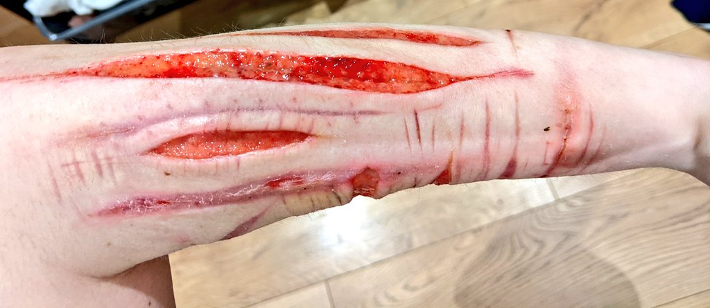 3PorridgeBears's tweet photo. Defo hit fascia, dunno how to feel tbh. I wish I took photos yesterday cause it looks so small now :/ https://t.co/RRd9OPA0fe
