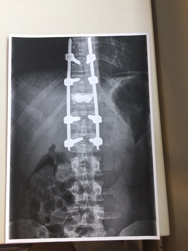 Dynikoo's tweet photo. Schlitten fahren war cool. Wirbel hat sich jedoch verabschiedet bei der letzten Abfahrt. Trage jetzt seit Neujahr bisschen Titan im Rücken. 🤖 https://t.co/XdmALFOyvS