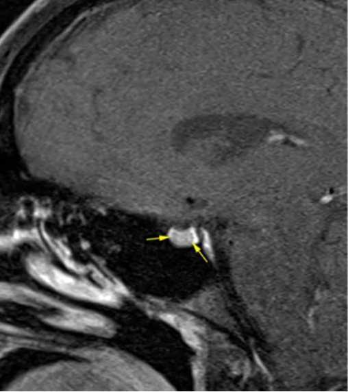 neurosurgatlas's tweet photo. ACTH-secreting adenomas are often found in the middle third of the gland, while prolactin- or growth hormone-secreting adenomas are located laterally. What other unique features differentiate these tumors?
#Endocrinology #PituitaryTumors #HormoneSecretion #AdenomaResearch https://t.co/d9PZVPcztP