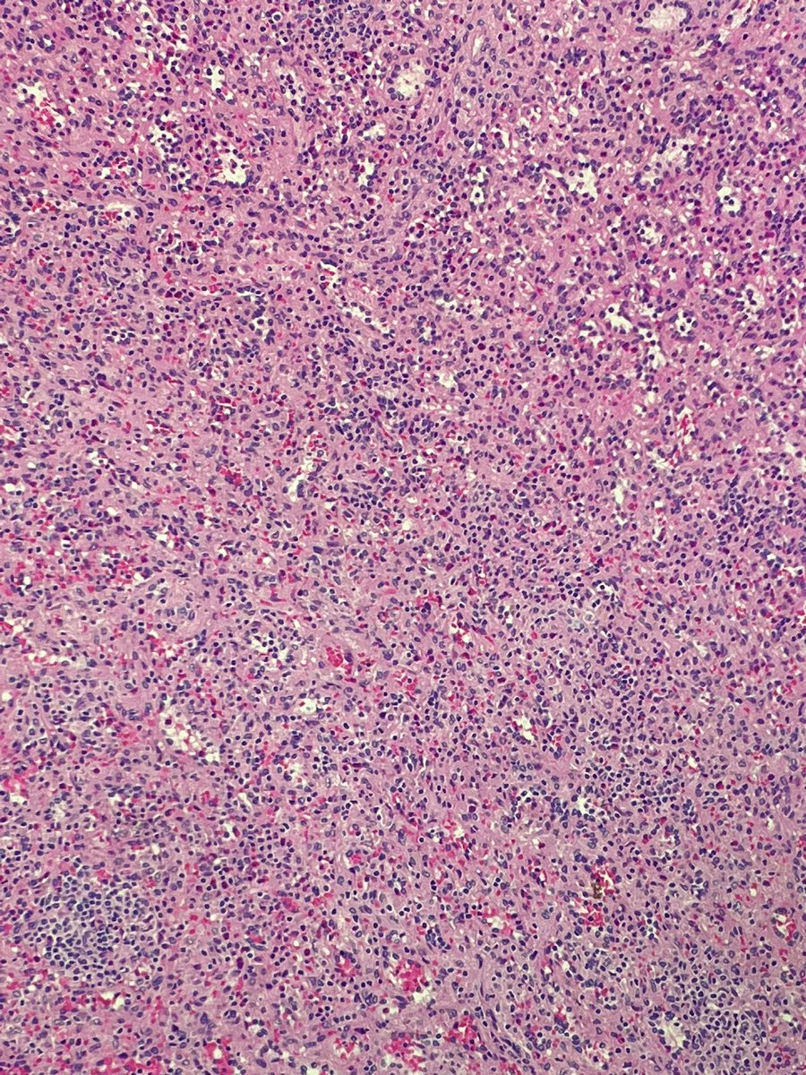 Soft tissue, abdominal wall, debridement:

Hx: Non healing wound. This is what you see.

How would you sign it out?
What stains would you order?

#PathX #pathquiz <a href="/UMichPath/">Michigan Pathology</a>