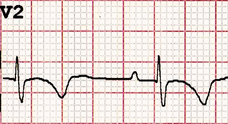 Joscarod's tweet photo. There are very precise features to identify right ventricular strain on EKG, nevertheless focusing on one or two leads for a certain pathology on various EKGs can help you notice small but very distinct signs. #EKG #FIT #ACC #ESC #CardioTwitter https://t.co/zUUfq6DAFt
