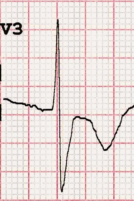 Joscarod's tweet photo. Some of the features you can find on V2-V3 are:
- Downsloping ST segment depression 
- ST rectification
- Deep inverted asymmetrical T waves 
- R > S 
- QRS Fragmentation 
- RBBB
- High Voltage P waves https://t.co/FSWu5QaEy0