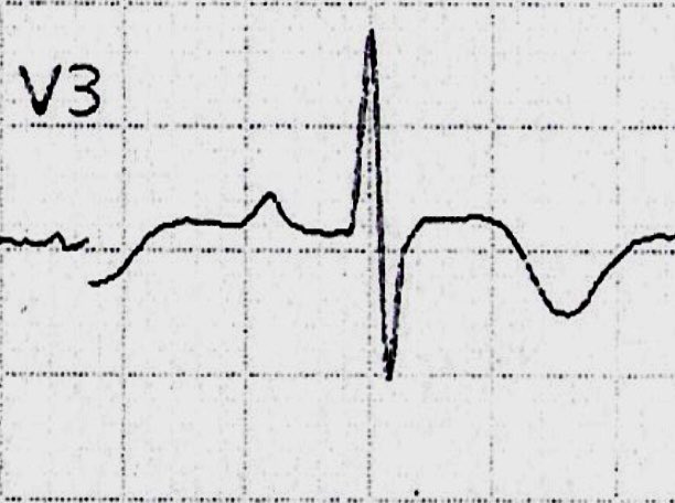 Joscarod's tweet photo. Some of the features you can find on V2-V3 are:
- Downsloping ST segment depression 
- ST rectification
- Deep inverted asymmetrical T waves 
- R > S 
- QRS Fragmentation 
- RBBB
- High Voltage P waves https://t.co/FSWu5QaEy0