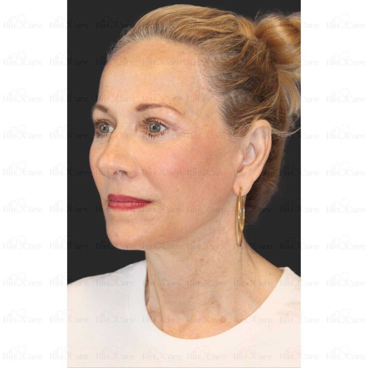 rinucare's tweet photo. #NeckLift #NeckLiftSurgery #FacialRejuvenation #TightenYourNeck #YoungerLookingNeck #NeckContour #NeckLiftResults #CosmeticSurgery #PlasticSurgeryResults #NeckTransformation #NeckLiftTurkey #CosmeticTourismTurkey #PlasticSurgeryTurkey #TurkeyAestheticJourney #NeckLiftIstanbul https://t.co/ujAWXm4RAj