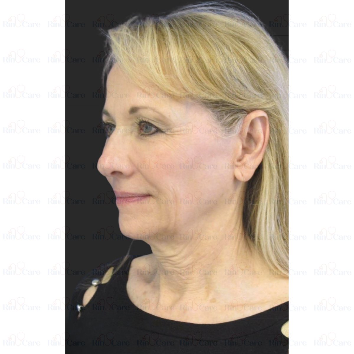 rinucare's tweet photo. #NeckLift #NeckLiftSurgery #FacialRejuvenation #TightenYourNeck #YoungerLookingNeck #NeckContour #NeckLiftResults #CosmeticSurgery #PlasticSurgeryResults #NeckTransformation #NeckLiftTurkey #CosmeticTourismTurkey #PlasticSurgeryTurkey #TurkeyAestheticJourney #NeckLiftIstanbul https://t.co/ujAWXm4RAj