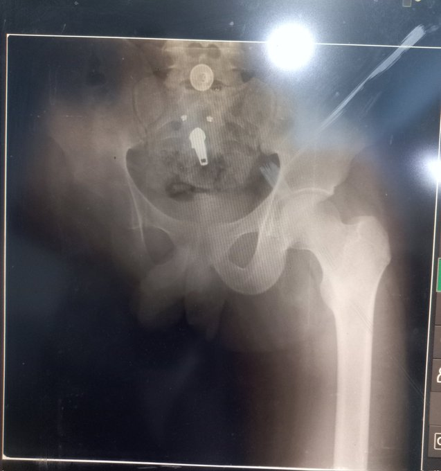 qs4rr's tweet photo. I am very sad because my🦵was completely amputated suffer from severe pain😭due to lack of medicine, food, &amp; Cold

Please pray for me
https://t.co/RyUVeym0uY https://t.co/P0UrlvdxL1