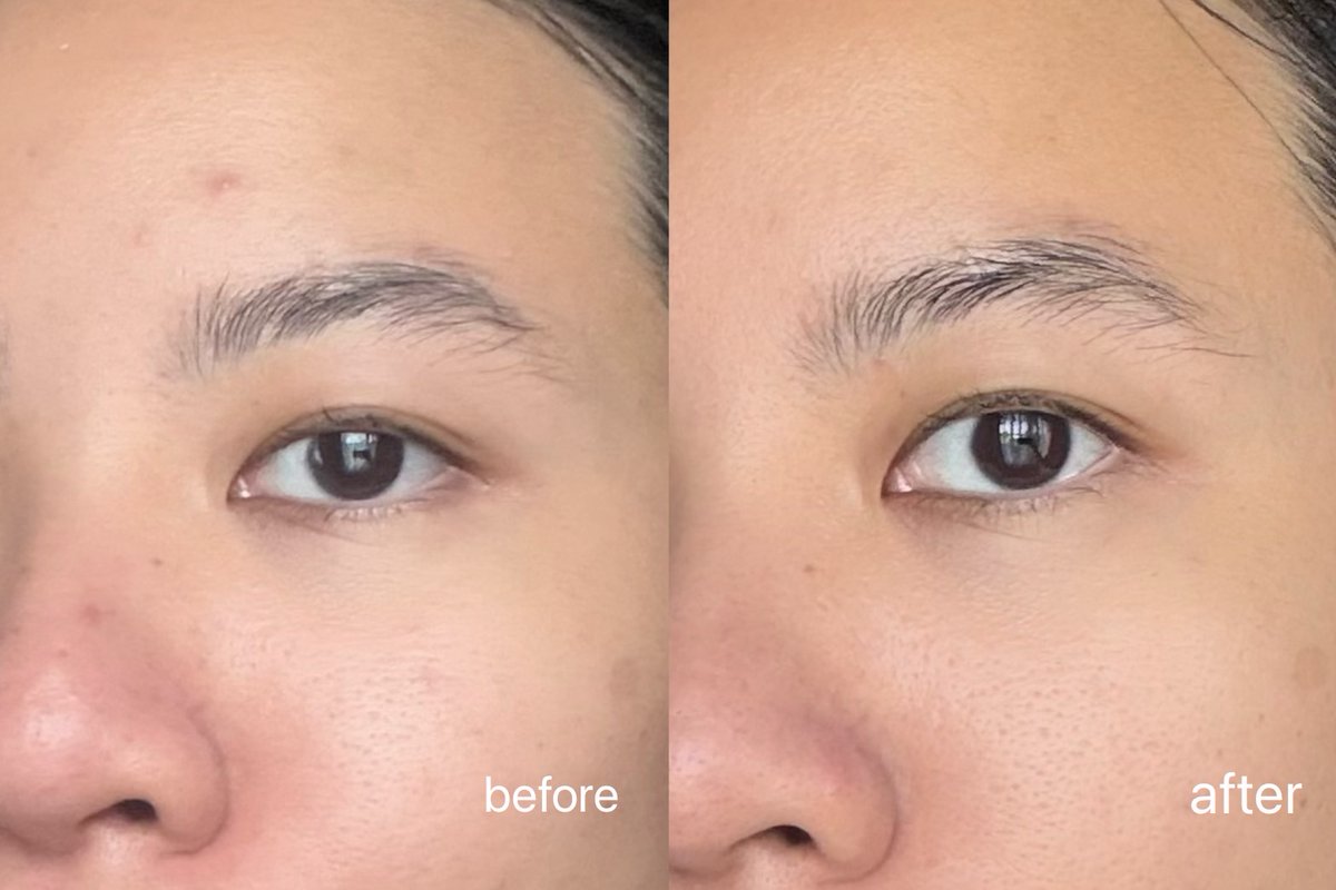 Eucerin เขาไม่ได้มาเล่นๆอีกแล้ววว ช่วงอากาศเย็น หน้าแห้ง สิวบุก ขอป้ายยาตัว Triple Effect Serum เซรั่มที่จะช่วยจบทุกสิวและรอยสิวซ้ำซาก ใช้คู่กับ Gel to Foam Cleanser (ใช้มาปีกว่าแล้ว ชอบมากกก)​ บอกเลยว่าจึ้ง เห็นผลตั้งแต่แรกที่ใช้ สิวแห้งไว สิวลดลง รอยแดงจากสิวก็ค่อยๆหายไปด้วย ที่สำคัญมีสารสำคัญที่แพทย์ผิวหนังแนะนำในการรักษาสิว ทั้ง Salicylic Acid ลดสิวลดการอุดตัน และ Thiamidol® ที่ลดรอยสิวตั้งแต่ต้นตอ รู้งี้ใช้คู่กันมานานแล้วววว