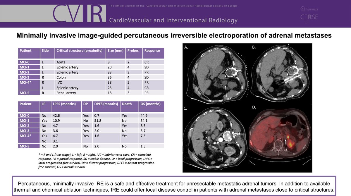 CVIR_Journal's tweet photo. Check out this #shortcommunication 📖
Minimally Invasive Image-Guided #Percutaneous Irreversible Electroporation of Adrenal Metastases
https://t.co/iyTbpLL3IV https://t.co/IcFNZxCvJW