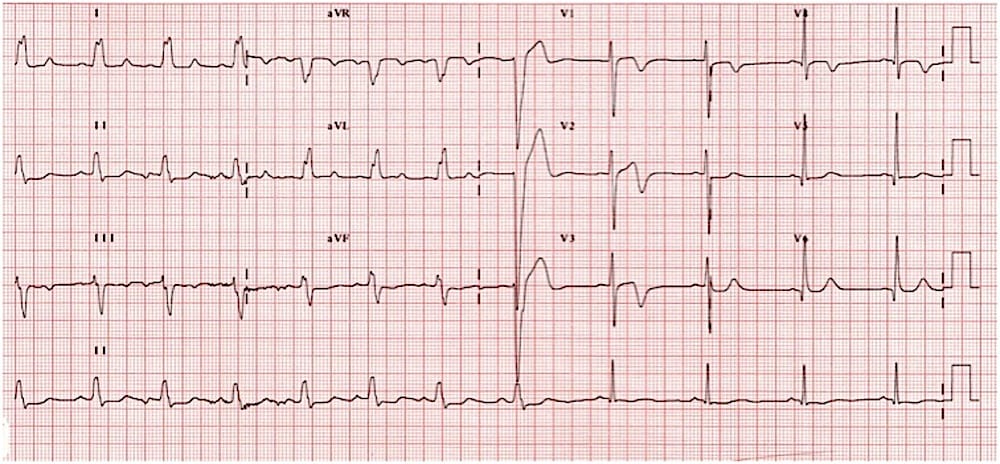 LITFL (@litflblog) on Twitter photo Is it possible to be pain-free and in VT? Our latest ECG Exigency case explores the peculiar ECG of a patient awaiting a bed for chest pain investigation. Check it out! litfl.com/pain-free-and-…
#MedEd #MedTwitter #CardioTwitter #FOAMed Is it possible to be pain-free and in VT? Our latest ECG Exigency case explores the peculiar ECG of a patient awaiting a bed for chest pain investigation. Check it out! litfl.com/pain-free-and-…
#MedEd #MedTwitter #CardioTwitter #FOAMed