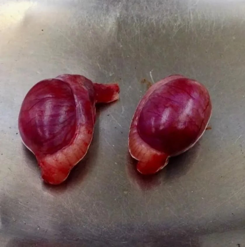 Smart1Doctor1's tweet image. What you see here are skinless male testicles..
.
.
.
.
#MaleAnatomy #Testicles #MedicalEducation #HumanAnatomy #Urology #HealthAwareness #ReproductiveHealth #AnatomicalStudy #MedicalIllustration #Healthcare #SexualHealth #MaleReproductiveSystem #Pathology #HealthScience…