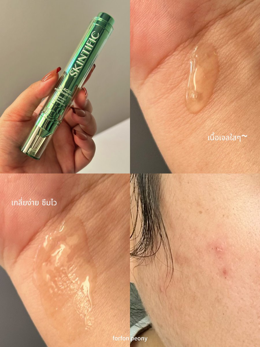 Skintific ออกโปรดักส์มาใหม่เป็นเจลแต้มสิว ความเก๋คือมาในแพคเกจเข็มฉีดยาสูญญากาศ ชนะไปเลยค่ะ ชอบมาก😂

เอาจริงเราเพิ่งได้ลองใช้ไม่กี่วัน แต่ผลลัพธ์โอเคเลยนะ ส่วนตัวใช้แล้วเห็นผลเรื่องปลอบประโลมผิว ลดการอักเสบดี ทำให้หัวสิวแห้งเร็ว ตัวนี้เน้นลดการระคายเคือง ปลอบผิว+ลดรอยแดง และผลัดเซล์ผิว ควรแต้มเฉพาะจุด สัปดาห์ละ 2-3 ครั้งก็พอน้าา