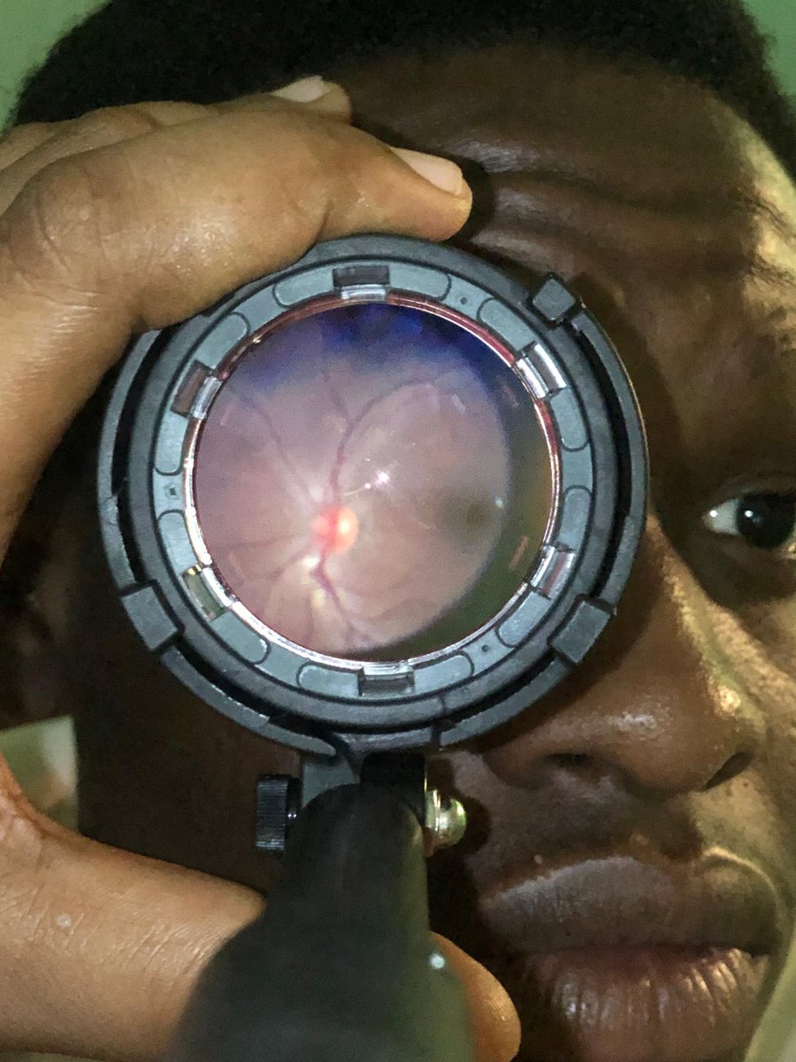 justbedebonair's tweet image. Was the subject of a fundoscopy sesh today.....it was fun. 
Here's my retina. 

#optometry #optometrystudent #fundoscopy #fundusimaging