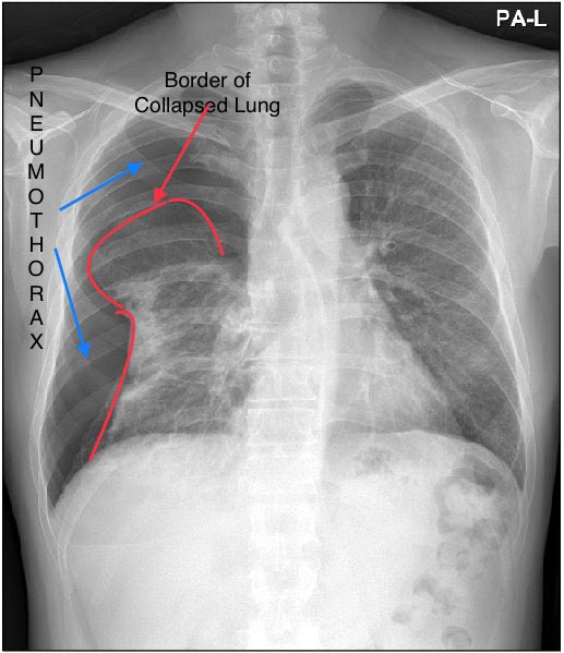 -Any Hx of TB/ILD/Granulomatous Lung disease/COPD prior to starting TNF-targeted therapy ?
➡️Worsening of RA associated ILD or granulomatous infection of Lung leading to ➡️ Etanercept induced Pneumothorax