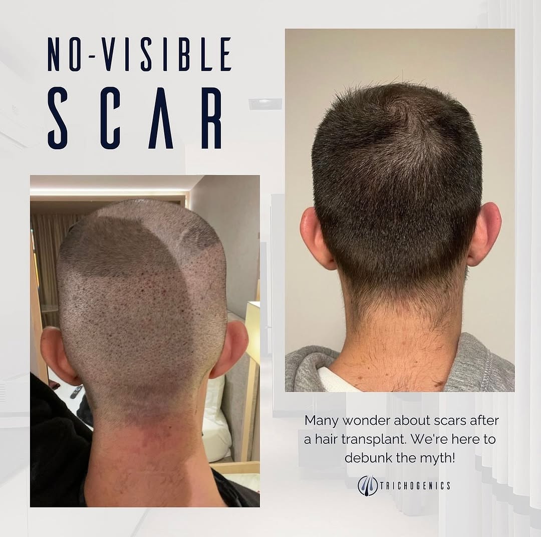 trichogenics_'s tweet photo. Scarless Hair Transplant! 🔮 Our expert surgeons @drasiperetz and @drericperetz use advanced FUE techniques, leaving no visible scars behind #HairTransplantMagic #FUE #Trichogenics #HairRestoration #NoScars https://t.co/bukH0LrI7v
