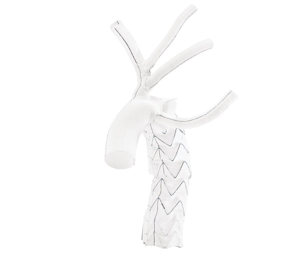 ChadiAludaat's tweet photo. Trifurcated Evita Open neo: a game changer in the management of Thoracic Aortic Aneurysm and Dissection (TAAD). Revolutionizing outcomes in complex aortic surgery. #CardioTwitter #Cardiovascular #MedTwitter #TAAD #AorticSurgery @ArtivionInc https://t.co/2oY2OqxxWW